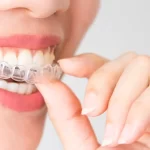 7 Benefits of Getting Invisalign Treatment